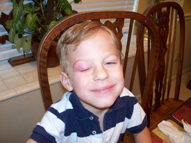 Fri 22 Oct 2010 08:00:55 AM

Andrew and Dad fished in a lake in OPCC on Thursday afternoon. We caught three nice bass but Andrew was bitten three times by a mosquito. One bite was on his eyelid and it reacted very badly.