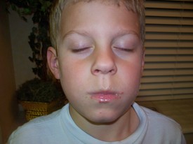 Sun 27 Nov 2011 08:03:43 PM

Andrew contracted what appeared to be one of the hand, foot, and mouth disease viruses. This was one of the worst sore throats Dad had seen and the boils and blisters just added insult to injury.