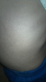 Thu 05 Jan 2012 08:34:17 PM

An ugly rash appeared on Andrew's torso for 2-3 days. It was mildly painful to him, irritated by clothes and bed sheets, but it went away on its own.